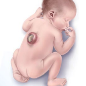 Baby with spina bifida.png